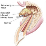 Drawing of root canal where inflamed or infected tissue is removed