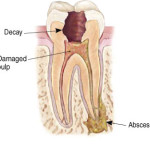 Drawing of decayed tooth and damaged pulp