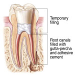 Drawing of temporary filling for root canal